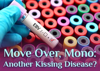 Bellevue dentists, Dr. Mack & Dr. Wachter at Family Dentistry of Bellevue talk about a kissing disease you might be less familiar with than mononucleosis.